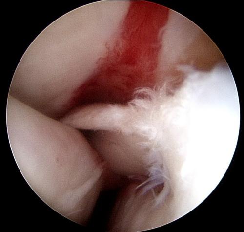 manica-flexoria-injury
